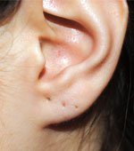 Corectia urechilor (otoplastia)