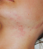 Tratarea pielii post acneice